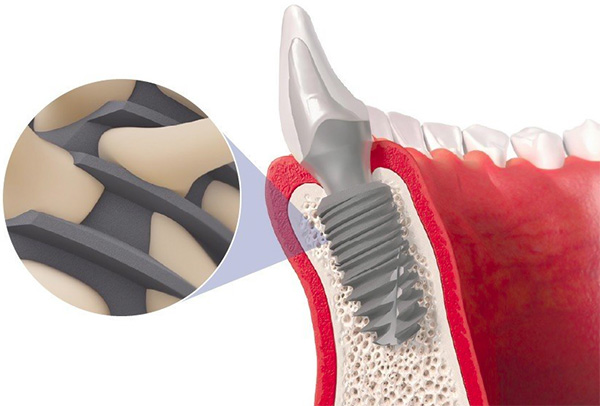 Implant tích hợp xương