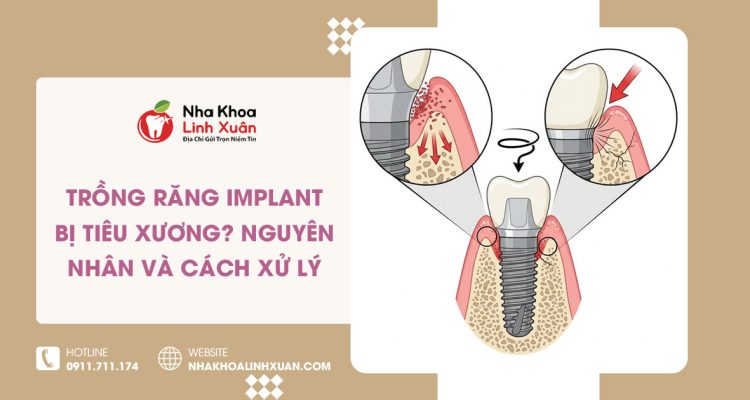 Trồng răng Implant bị tiêu xương: Nguyên nhân và cách xử lý