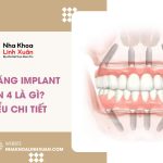Trồng răng Implant All On 4 là gì? Tìm hiểu chi tiết