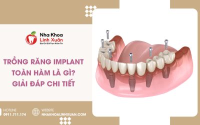 Trồng răng Implant toàn hàm là gì? Giải đáp chi tiết