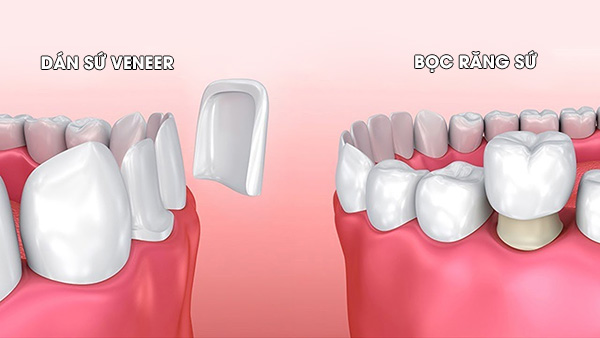Dán sứ Veneer với Bọc răng sứ