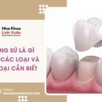 Mão răng sứ là gì? Cấu tạo, các loại và những điều cần biết