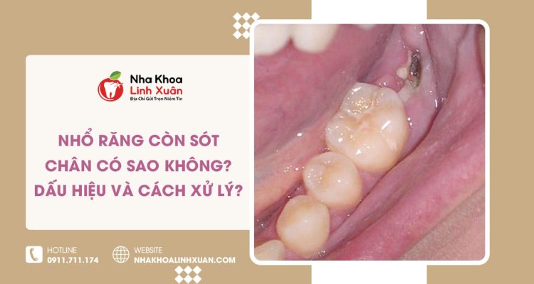 Nhổ răng còn sót chân răng có sao không? Cách xử lý