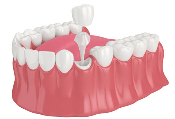Phục hình cùi giả răng giả Zirconia