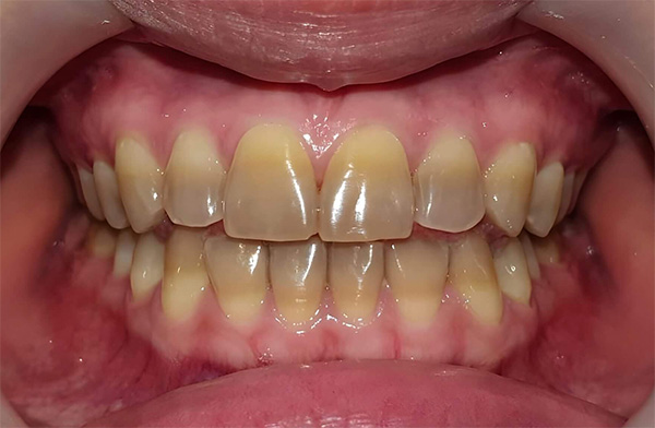 Răng nhiễm Tetracycline