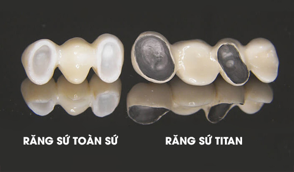 Răng sứ Titan và Răng toàn sứ