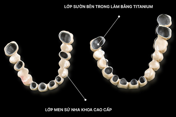 Răng sứ Titanium