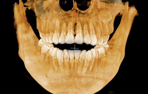 Cone Beam CT 3D