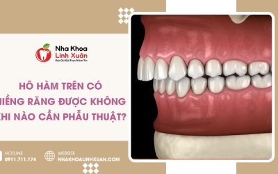 Hô hàm trên có niềng răng được không? Khi nào cần phẫu thuật?