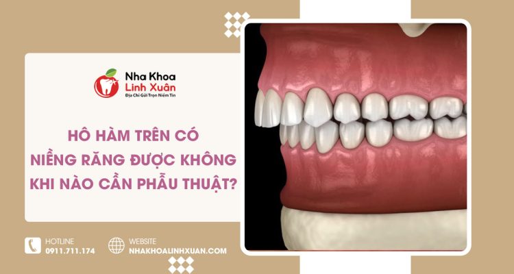 Hô hàm trên có niềng răng được không? Khi nào cần phẫu thuật?