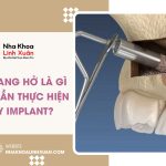 Nâng xoang hở là gì? Khi nào cần thực hiện khi cấy Implant?