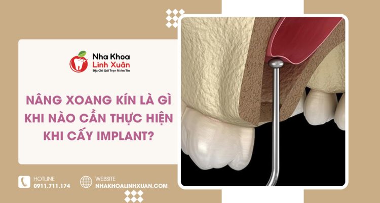 Nâng xoang kín là gì? Khi nào cần thực hiện khi cấy Implant?