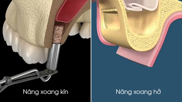 So sánh nâng xoang kín và nâng xoang hở