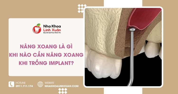 Nâng xoang là gì? Khi nào cần nâng xoang khi trồng Implant?