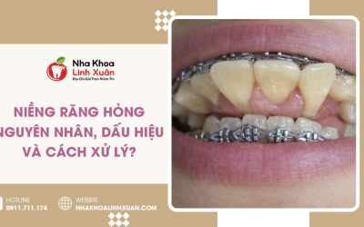 Niềng răng hỏng: Dấu hiệu, nguyên nhân, cách khắc phục