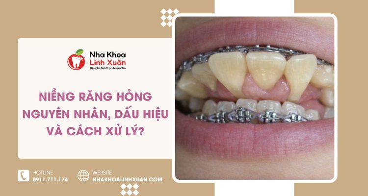 Niềng răng hỏng: Dấu hiệu, nguyên nhân, cách khắc phục
