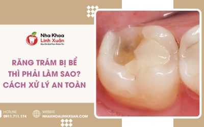 Răng trám bị bể phải làm sao? Cách xử lý an toàn
