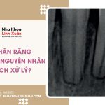 Tiêu chân răng khi niềng: Nguyên nhân và cách xử lý