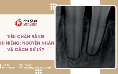Tiêu chân răng khi niềng: Nguyên nhân và cách xử lý