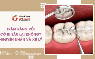 Trám răng rồi có bị sâu lại không? Nguyên nhân & cách xử lý