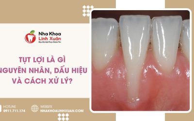 Tụt lợi là gì? Nguyên nhân, dấu hiệu và cách xử lý