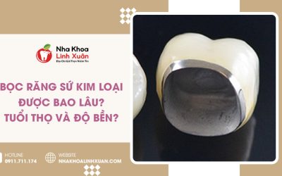 Bọc răng sứ kim loại được bao lâu? Tuổi thọ & độ bền