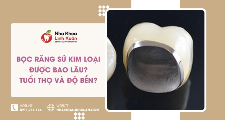 Bọc răng sứ kim loại được bao lâu? Tuổi thọ & độ bền