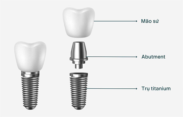 Cấu tạo Implant nha khoa