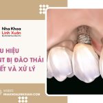 Dấu hiệu trụ Implant bị đào thải: Nhận biết và xử lý