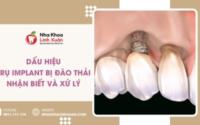 Dấu hiệu trụ Implant bị đào thải: Nhận biết và xử lý