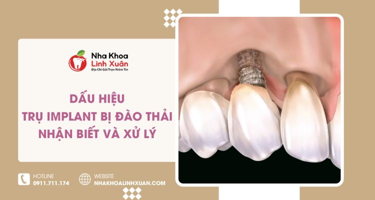 Dấu hiệu trụ Implant bị đào thải: Nhận biết và xử lý