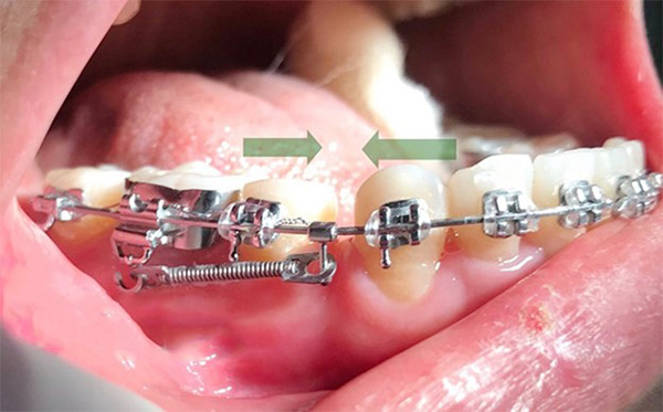 Đóng khoảng trong niềng răng