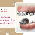 Đóng khoảng trong niềng răng là gì? Quy trình và lưu ý