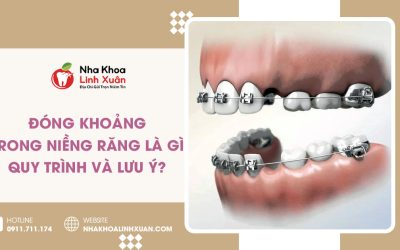 Đóng khoảng trong niềng răng là gì? Quy trình và lưu ý