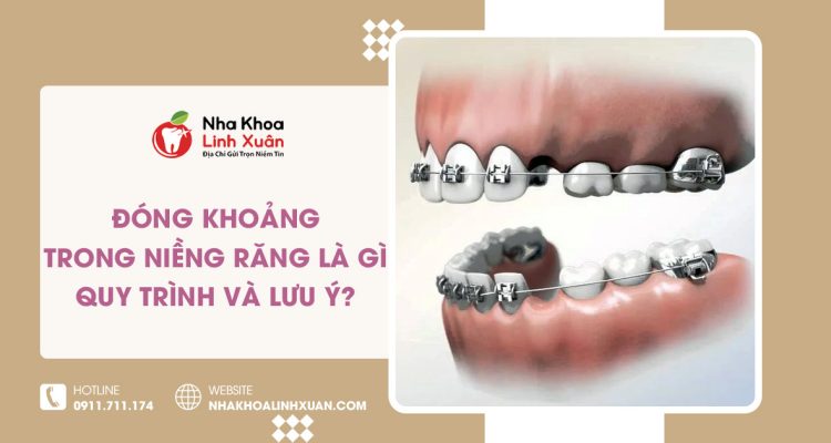 Đóng khoảng trong niềng răng là gì? Quy trình và lưu ý