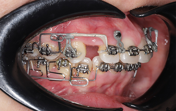 Đóng khoảng trong niềng răng