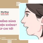 Hô hàm niềng răng có cải thiện không? Giải đáp chi tiết