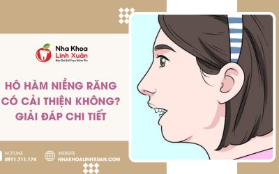 Hô hàm niềng răng có cải thiện không? Giải đáp chi tiết