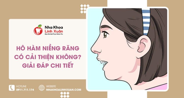 Hô hàm niềng răng có cải thiện không? Giải đáp chi tiết