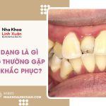Răng dị dạng là gì? Các dạng thường gặp và cách khắc phục