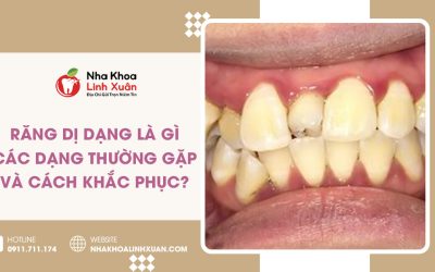 Răng dị dạng là gì? Các dạng thường gặp và cách khắc phục