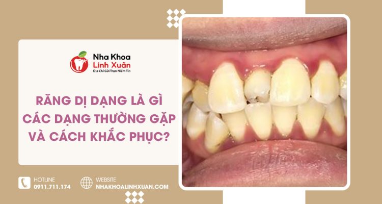 Răng dị dạng là gì? Các dạng thường gặp và cách khắc phục