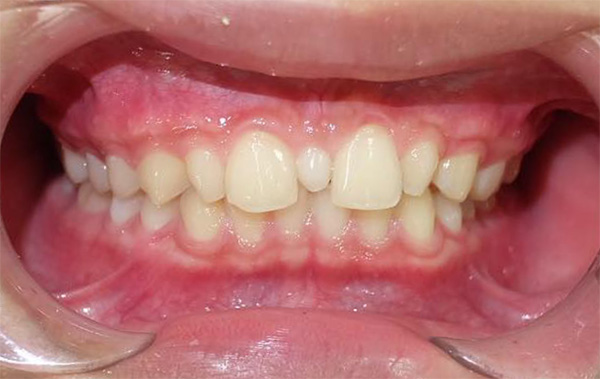 Răng dị dạng