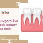 Răng khôn mọc thẳng có cần nhổ không? Giữ hay nhổ?