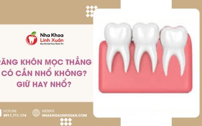 Răng khôn mọc thẳng có cần nhổ không? Giữ hay nhổ?