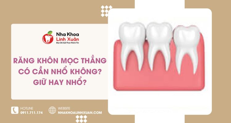 Răng khôn mọc thẳng có cần nhổ không? Giữ hay nhổ?