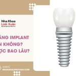 Trồng răng Implant có bền không? Dùng được bao lâu?