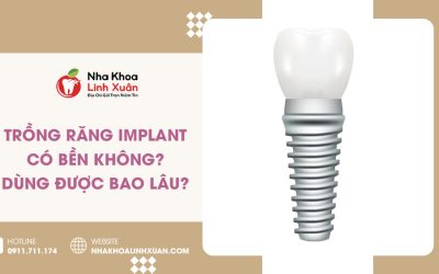 Trồng răng Implant có bền không? Dùng được bao lâu?